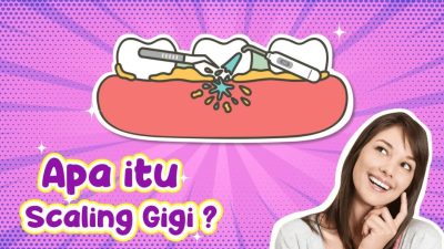 Apa Itu Scaling Gigi? Kenapa Penting dan Apa Saja Manfaatnya?