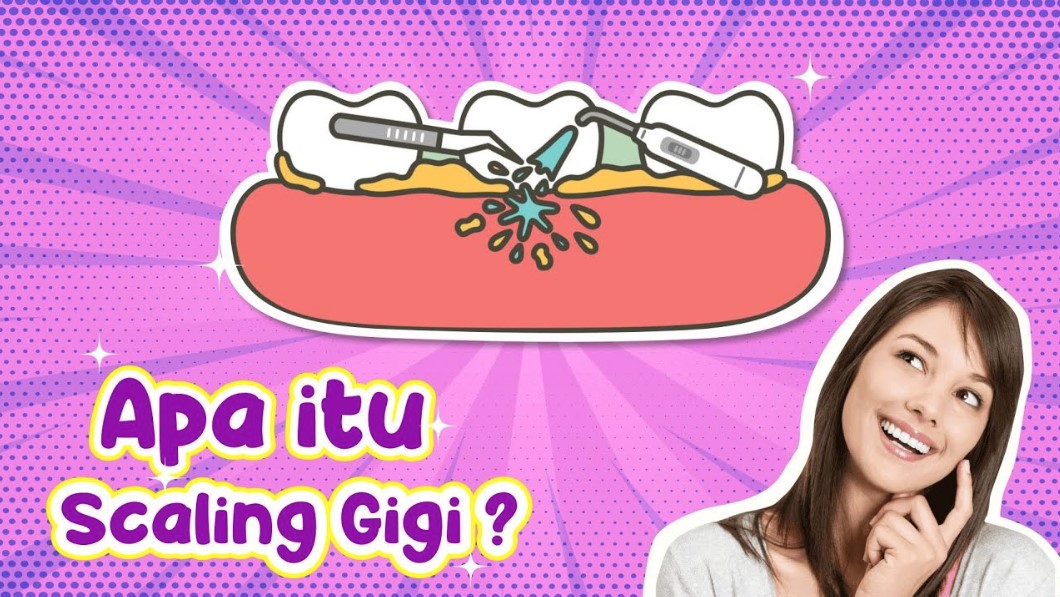 Cara Merawat Gigi Agar Tidak Perlu Scaling Terlalu Sering